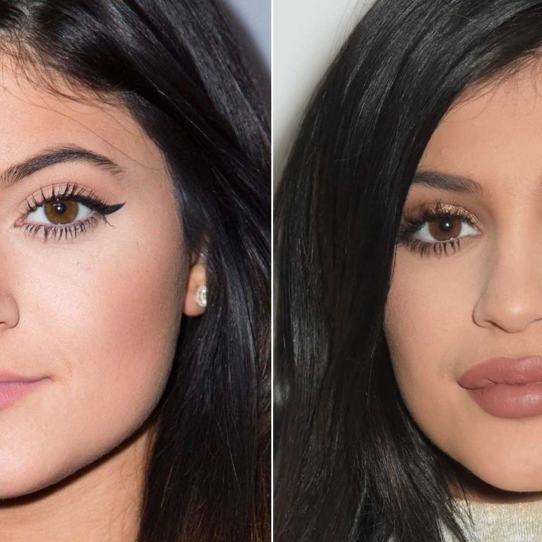 18 Facts About Lip Injections What You Should Know About Lip Augmentation