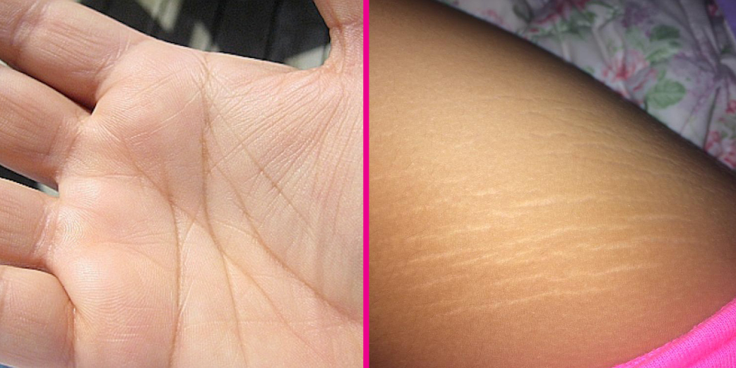  ThighReading Selfies Prove That Stretch Marks And Scars Are Beautiful