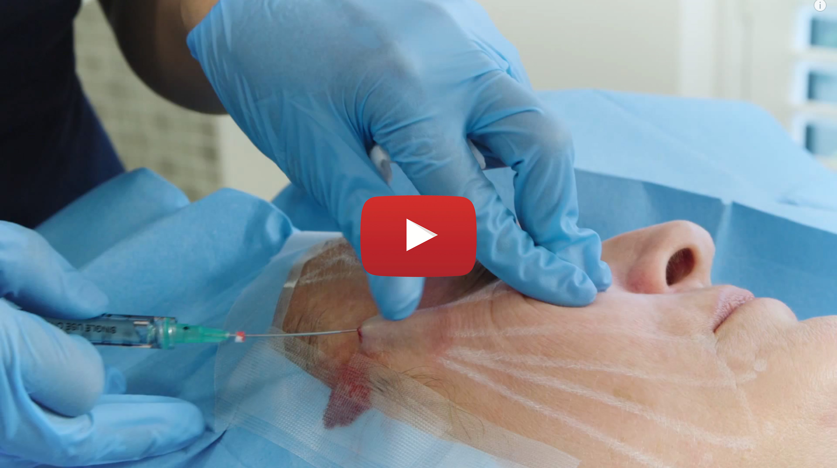 Thread Lift and PRP Face Lift Video