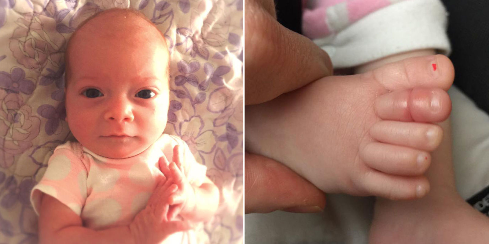 What to Do When Your Baby Has Toe Tourniquet Syndrome, Dad's Facebook