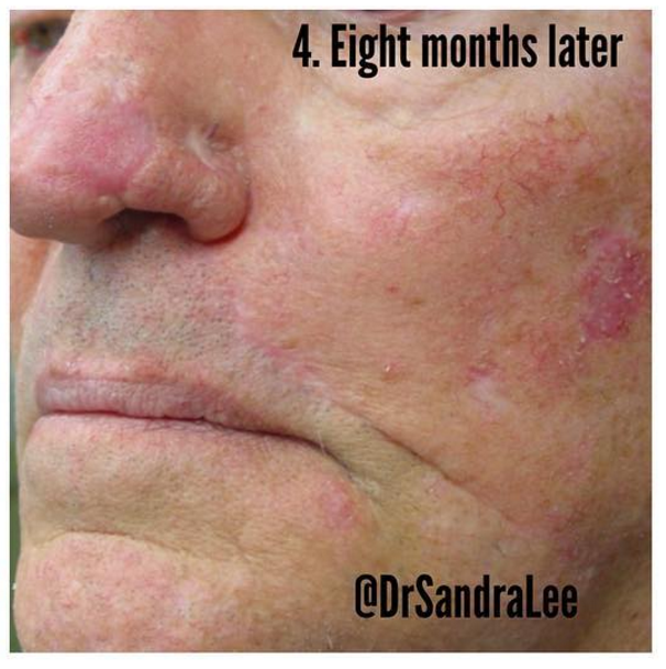 Photos of Skin Cancer Surgery — Skin Cancer Removal on The Face